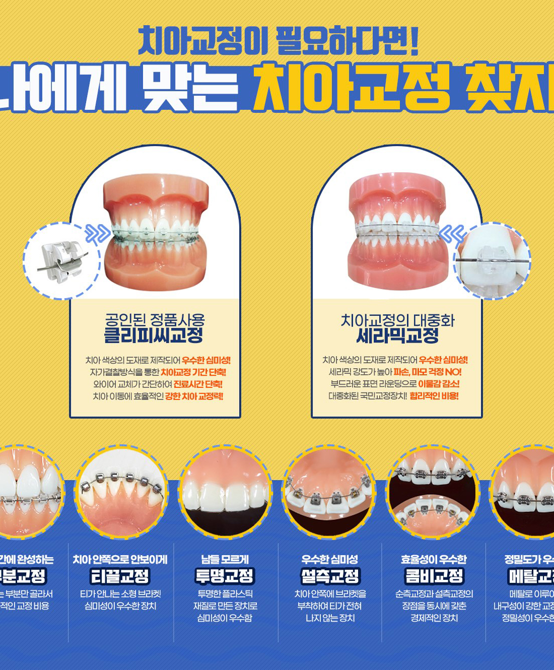 부천치과 교정종류